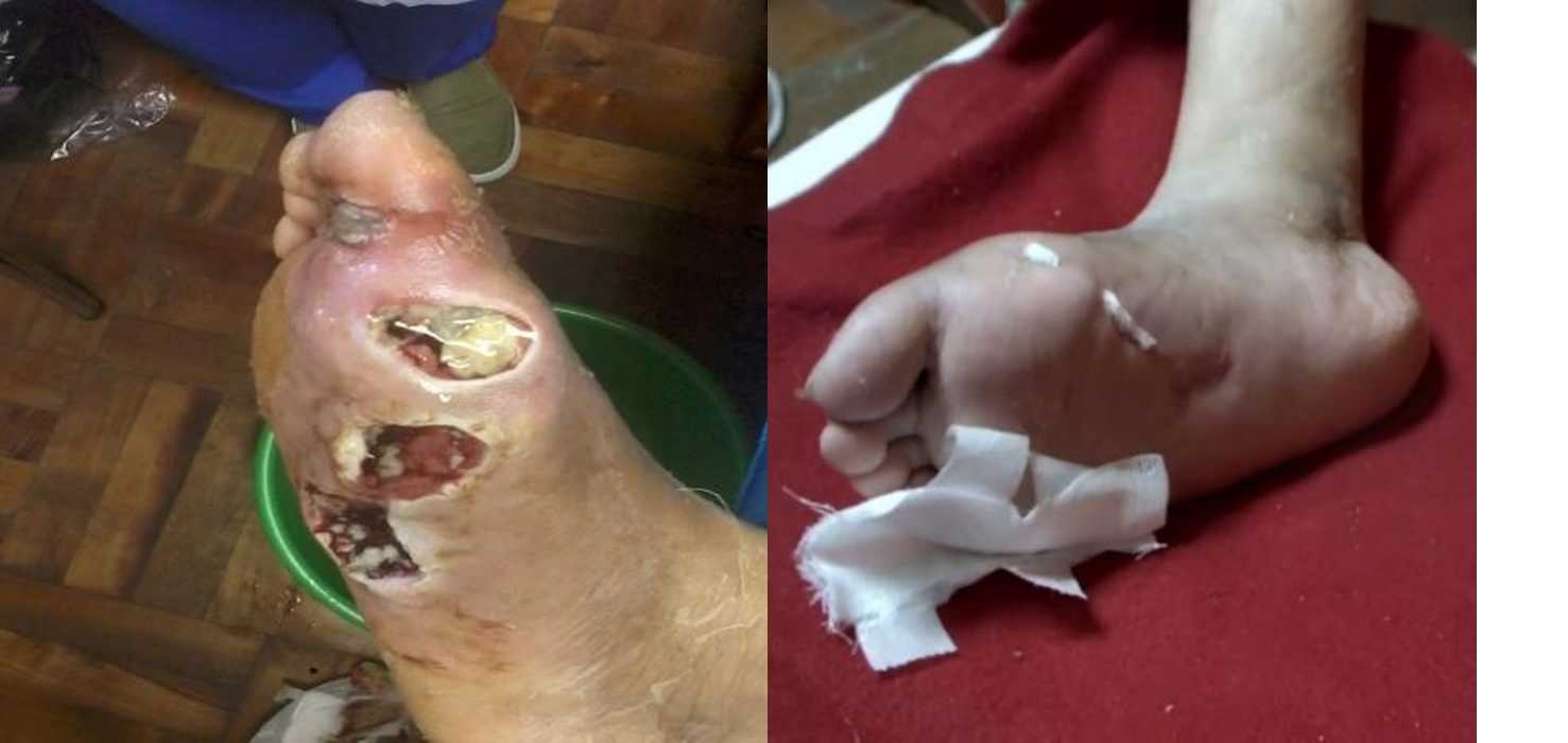 Before & After: Spider Bite